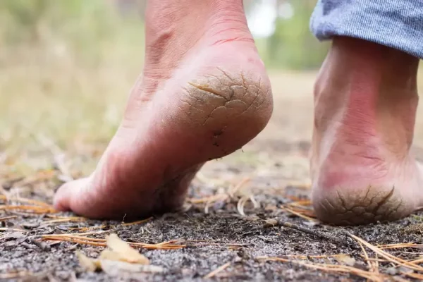 फटी एड़ियों की समस्या से जूझ रहे हैं? अपनाएं ये सरल और असरदार उपाय