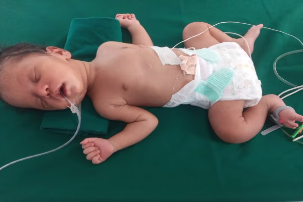 कोलकाता BM बिड़ला हार्ट हॉस्पिटल में दुर्लभ हृदय सर्जरी के बाद रिकवरी करती बच्ची